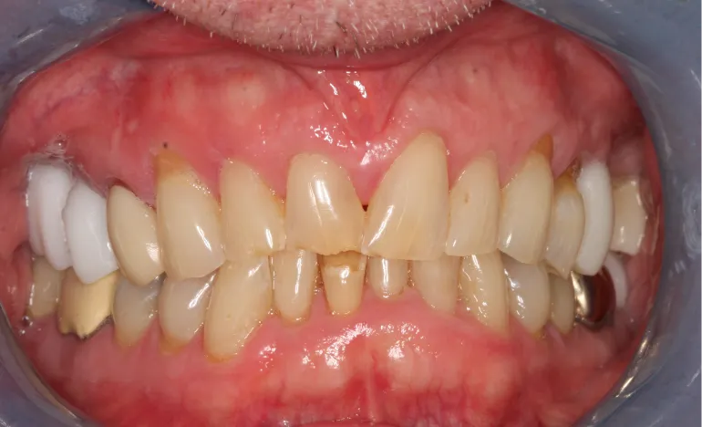A close-up of a person's teeth showing noticeable discoloration and irregular alignment.