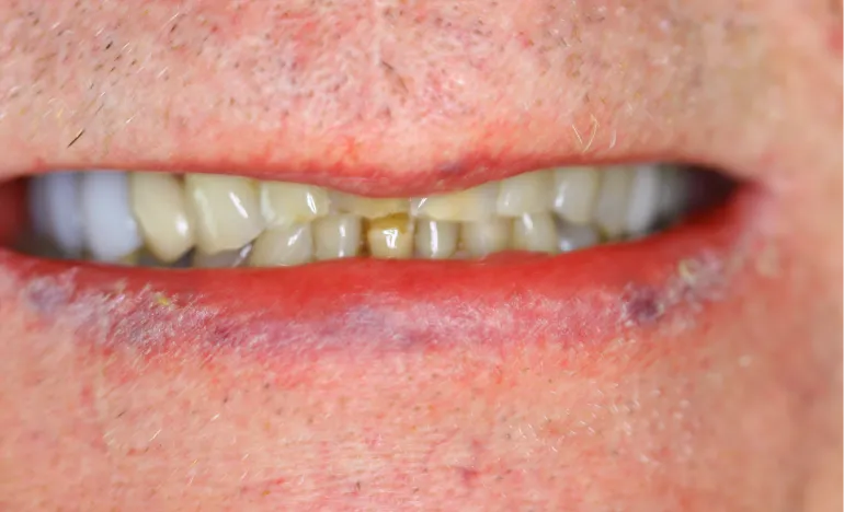 A close-up of a person’s mouth with chapped lips and slightly yellowed teeth.